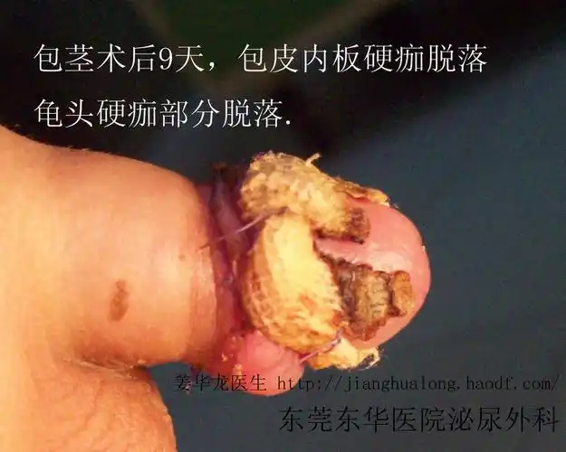 儿童包茎包皮环切术后恢复过程 - 好大夫在线