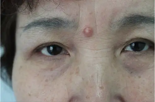 病理显示:表皮无明显改变,真皮内肿瘤细胞团块浸润,由立方形或多角形