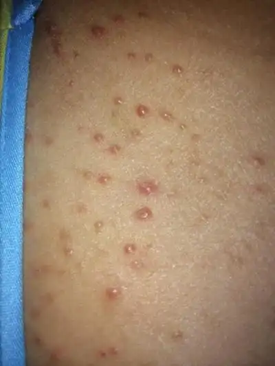 喀什疥疮医院_喀什治疗疥疮哪家医院好_喀什治疗疥疮最好的医院/排行