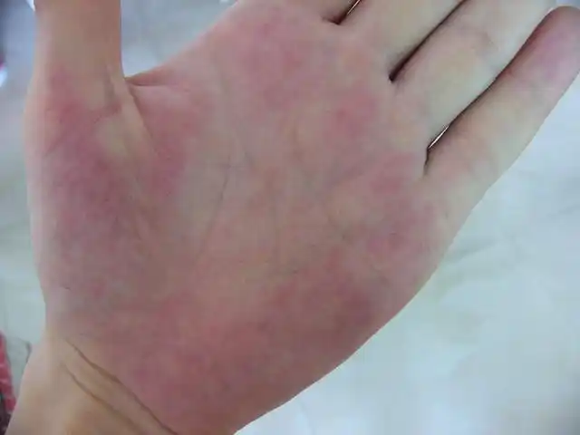 手心这个红斑是怎么回事