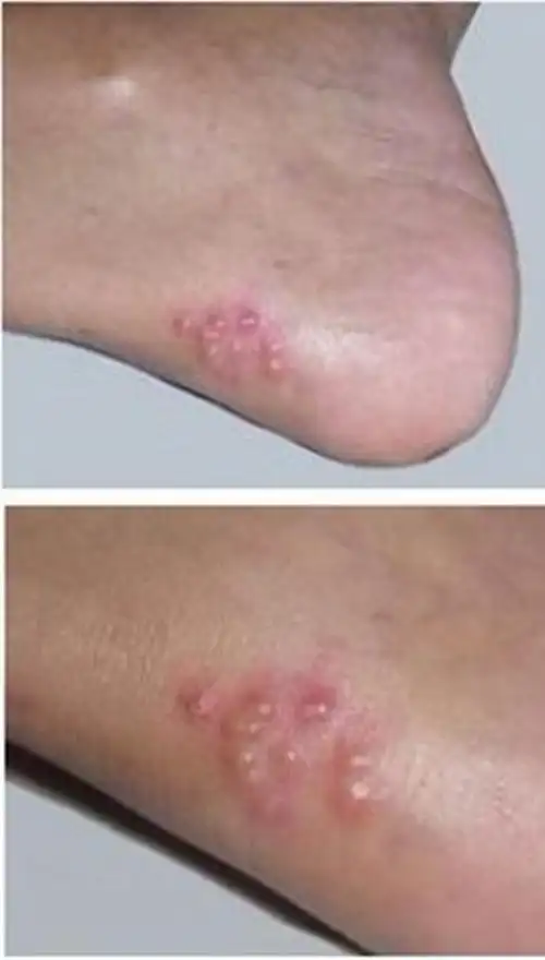 女性艾滋病窗口期症状图