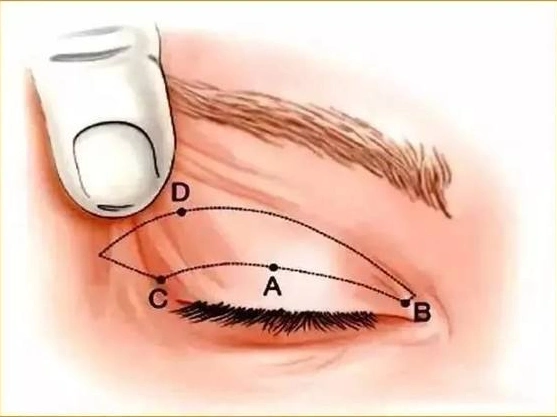 上眼睑松弛,双眼皮变窄该怎么办?