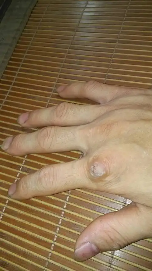 手指结的上面长颗黄豆大小的疙瘩是什么?不痛不痒的.