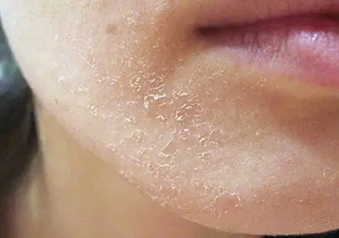 冬天洗完澡以后发现身上皮肤干燥起皮,该如何护理?