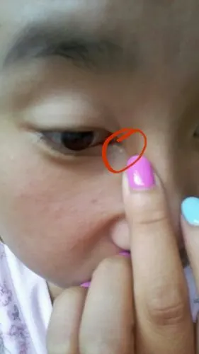 眼角长个疙瘩,不痛不痒的,咋回事.