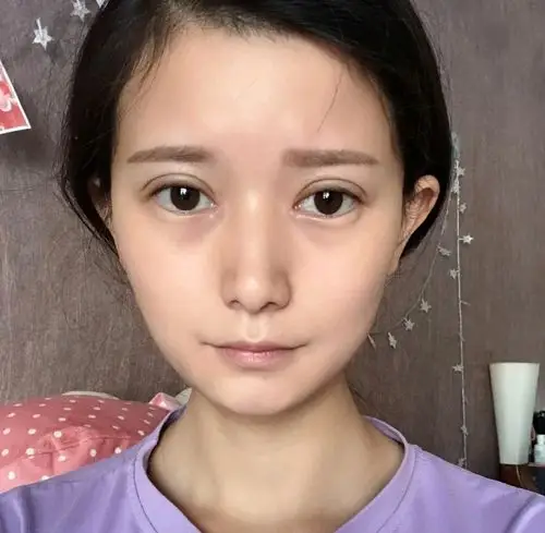 做的全切双眼皮,宽度是7.5mm,我觉得稍微有点宽_圈子-新氧美容整形