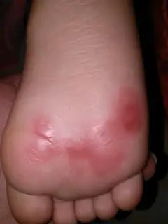 两岁宝宝前脚掌一片红