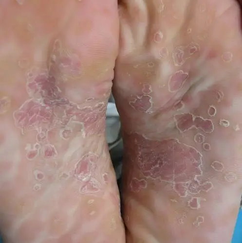 人得了一期梅毒怎么办图片