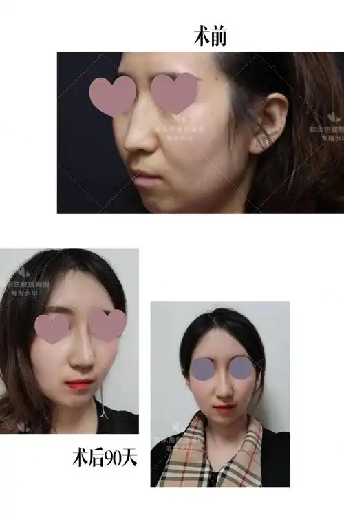 驼峰鼻矫正案例 - 好大夫在线