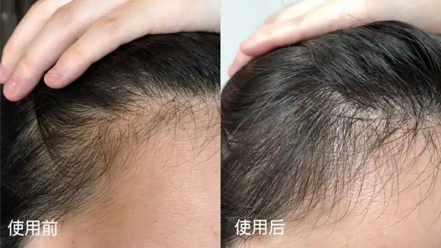 人到中年,除了头秃什么都不容易_效果