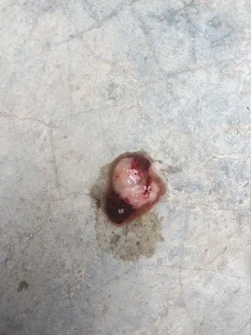 有图,介意者深慎入 药流后排出的孕囊从形状上能看出男女吗?排出可