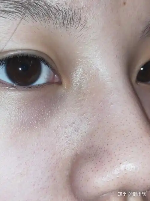 挤黑头留下的大鼻坑怎么才能弄好?