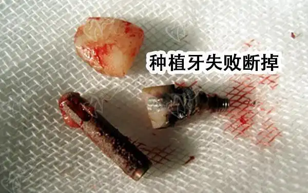 做了种植牙我好后悔