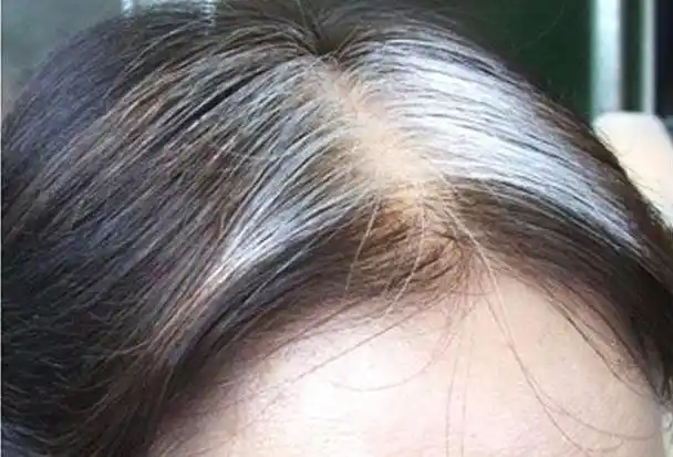 年轻人为什么头发会变白原因人到中年,最怕衰老,而白发一直都被视作"