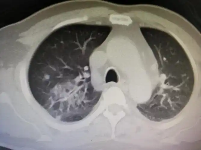 没有任何症状的肺结核