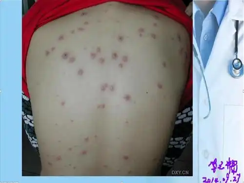 儿科常见的皮疹疾病及鉴别诊断