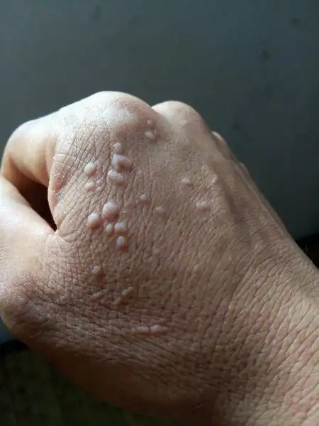 我手背上的小肉粒越来越多越大,怎么为?