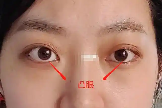 眼球向下看时,上眼睑不能跟随眼球下落,闭眼时上下眼睑不能完全闭合.