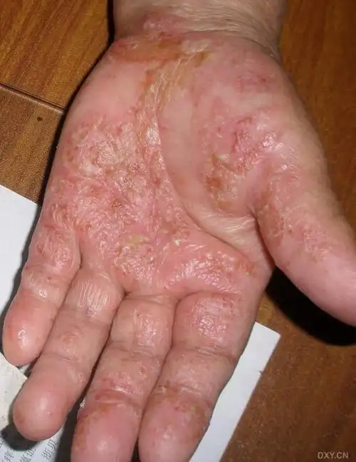 【病例讨论】手掌水泡,脓疱 [病例帖]