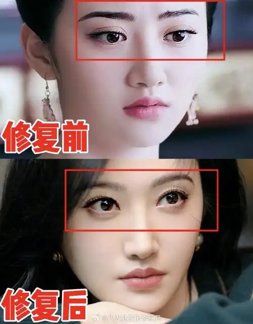 景甜修复完后的双眼皮还挺好看的