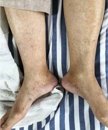 扩散糖尿病性肾病引起的双下肢水肿怎么办