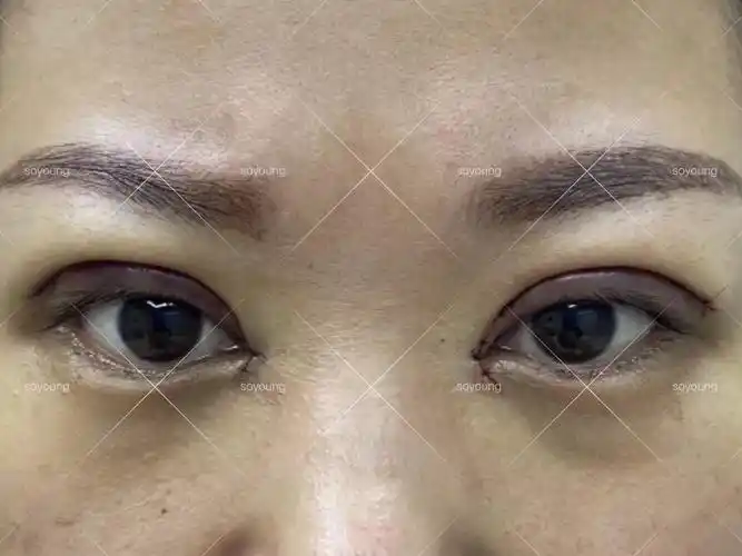 4年前做的埋线双眼皮,没多久松脱了,形成多皱褶.