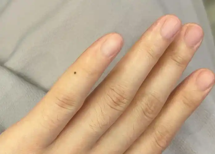 手上突然长了个痣