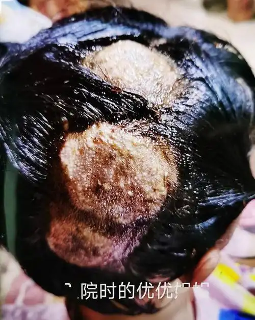 头皮发麻!姐弟俩先后因脓癣入院,问题竟出在家里来的"新成员"