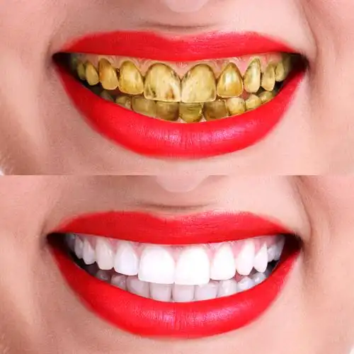 【牙白不求人】正品美牙仪冷光牙齿美白速效去大黄牙家用