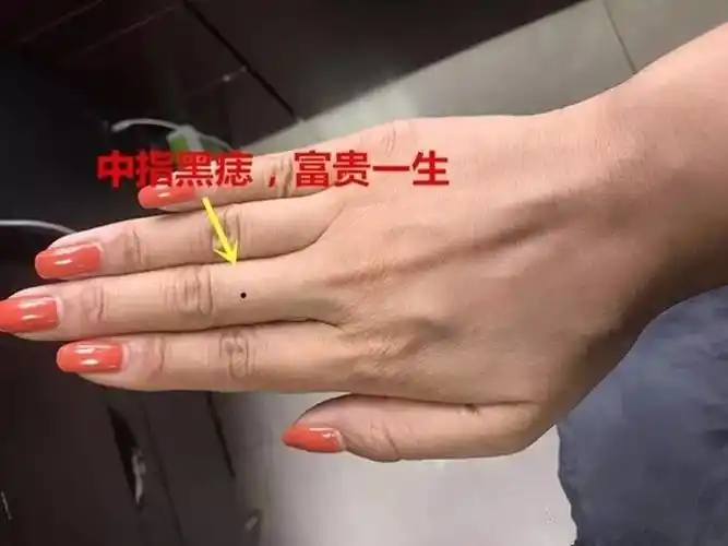 手掌手背有痣(手掌手背都有痣)