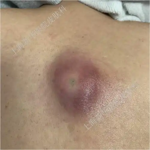 "粉瘤"是什么?该怎么治?总能挤出白色牙膏样东西.