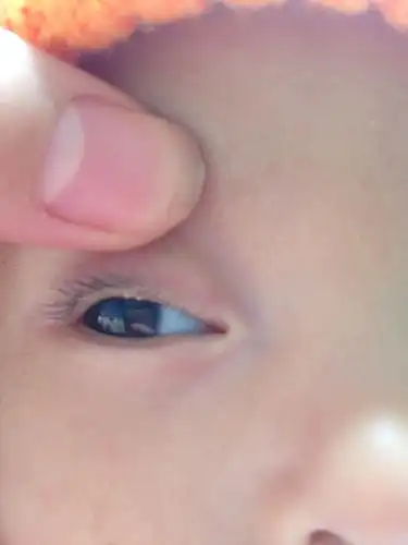 我家宝宝三个多月上眼皮内侧长了几粒白色的痘痘像粉刺