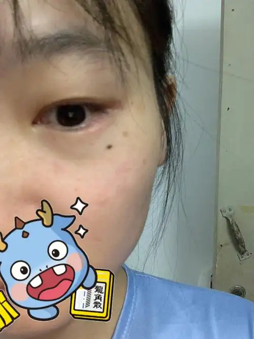 红霉素眼膏到底怎么涂