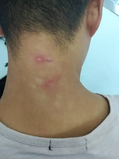 一觉醒来脖子上不知怎么搞得,,还有白斑,想知道是癣什么的吗破是不