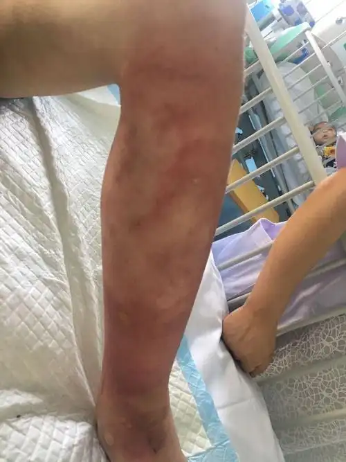 丹毒是一种皮肤的细菌感染,常见的致病菌是a组溶血性链球菌.