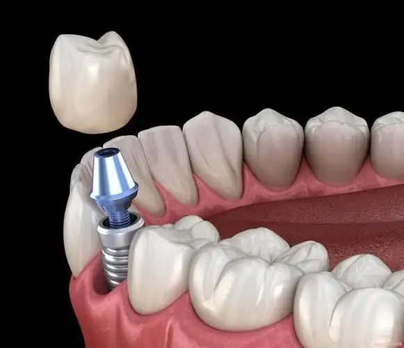 种植牙寿命多久种植牙流程复杂么医院和医生如何选不踩坑
