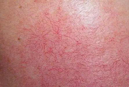 秘籍分享丨丹妮老师红血丝是如何形成的