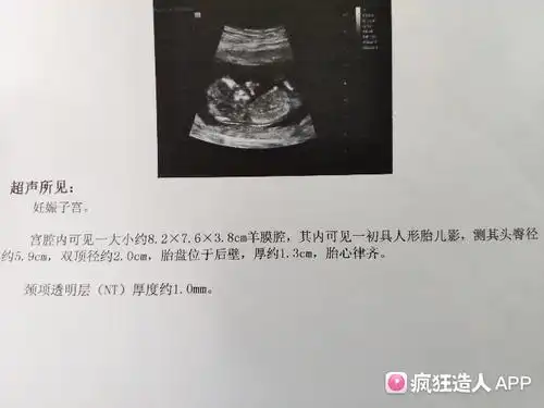 22周做的四维 是不是很明显的女宝看到了三条线,看来nub也不准