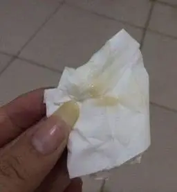 宫颈癌早期症状不典型,但常出现阴道出血,异常色泽分泌物等症状.