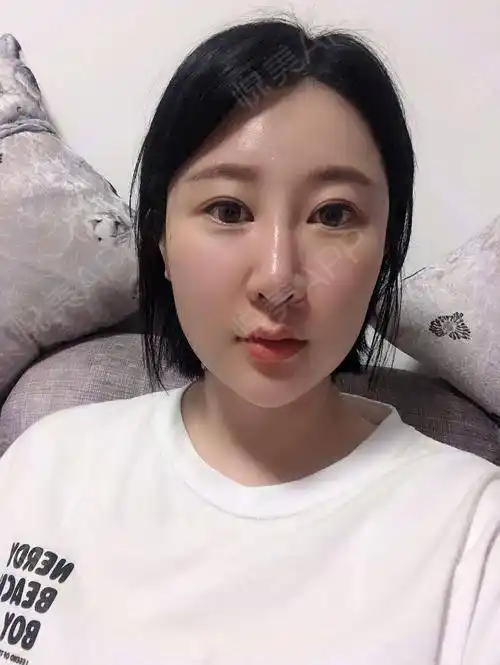 玻尿酸丰鼻基底术后7天_玻尿酸丰太阳穴术后7天_填充塑形术后7天_垫鼻