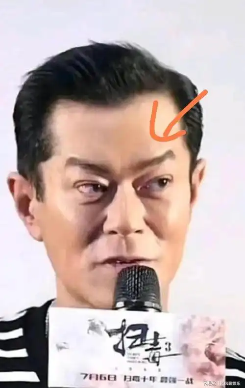 古天乐曾经多次进行整容手术,其中包括改双眼皮和拉皮等.