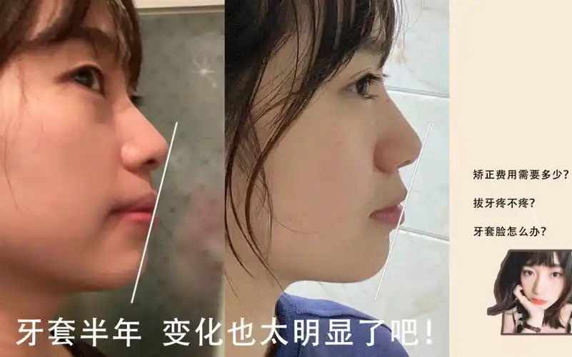 侧脸线条明显变化!戴牙套前期的准备和经验分享_哔哩哔哩_bilibili