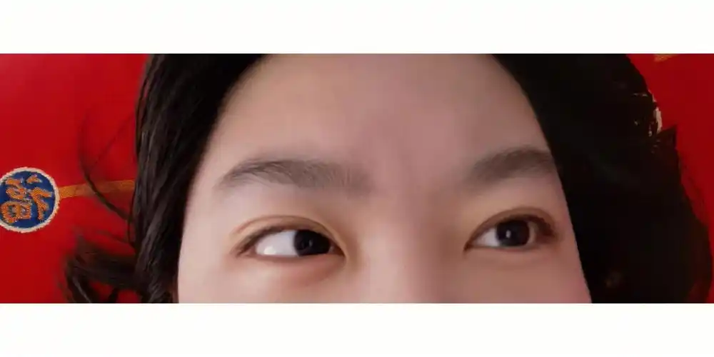 左眼袋肿了用不用去医院看看