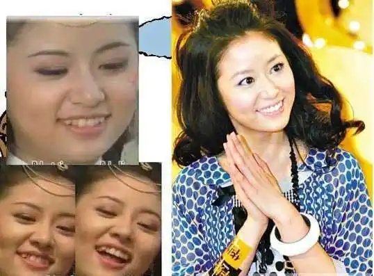 林心如牙齿整形后星途更辉煌