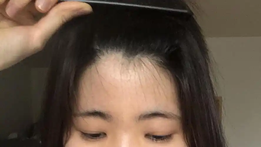 额头短窄发际线低太阳穴凹陷美人尖发质贼硬的孩子怎么办呢