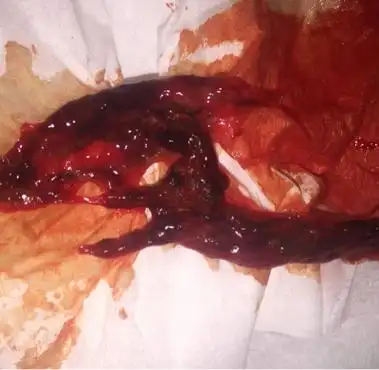 问答 怀孕期 推荐回答                     你好!很可能是自然流产!