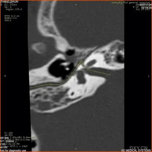 【转贴】颞骨ct扫描中的面神经