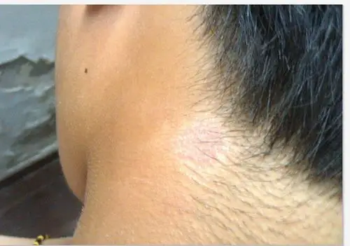 我脖子后面长了一个白色的斑点