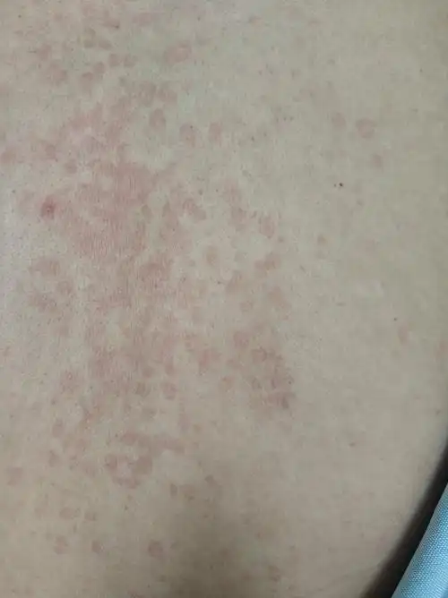 夏季躯干部位出现色斑,需当心"汗斑"_花斑癣_花斑癣症状 - 好大夫在线