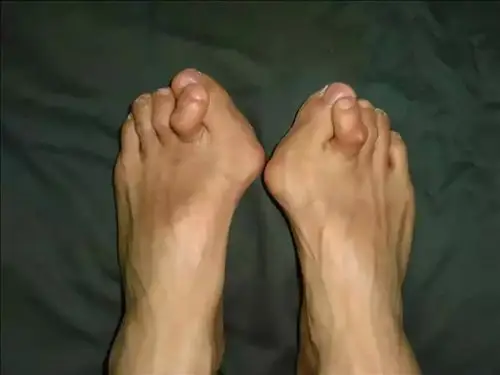 大脚趾疼大脚骨病您想知道的都在这